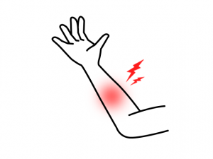 追突事故による腕の痛み…。何が損傷して症状があらわれるの？