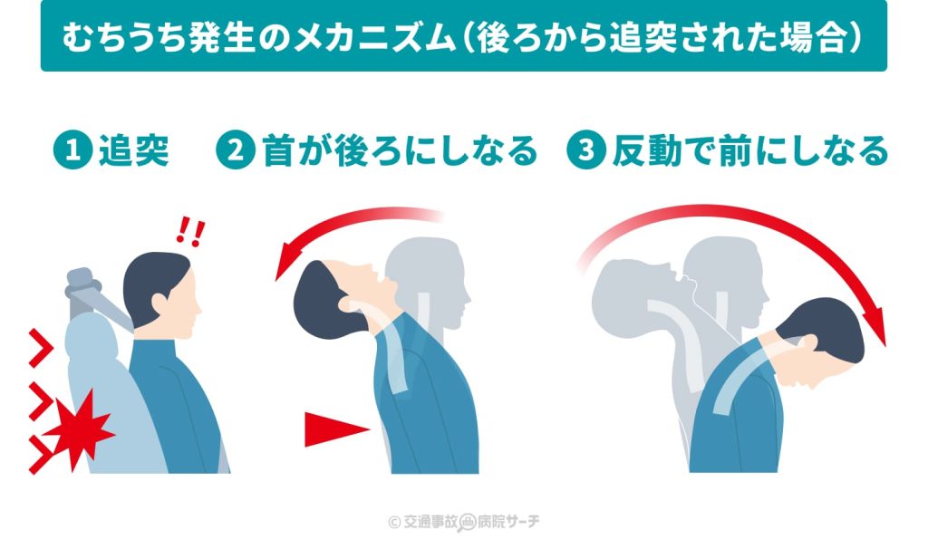 むちうち発生のメカニズム