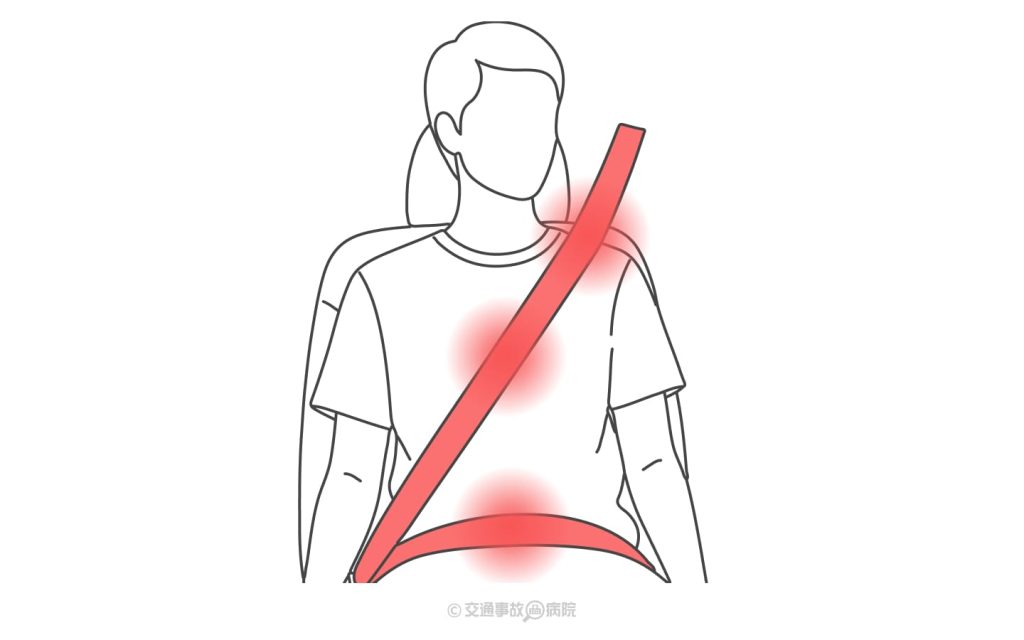 シートベルト外傷（損傷）