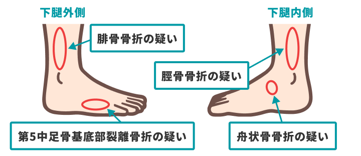 オタワの足関節ルール（骨折をしているときに触診で痛みが確認できる箇所4つ）